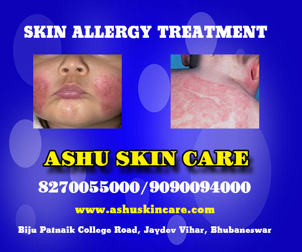 best skin allergy treatment clinic in bhubaneswar not far from hitech hospital